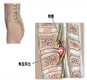 骨,任何部位的垫片,都有可能损坏突出,但常见的是颈部和腰部的椎间盘